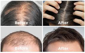 Hair Revital X – pour la perte de cheveux - comprimés – en pharmacie – composition